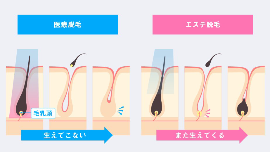求める効果が得られる脱毛方法を選ぶ