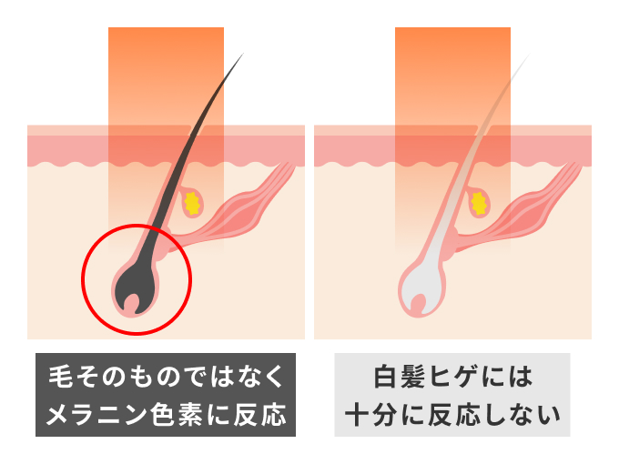 レーザー脱毛はメラニン色素に反応する