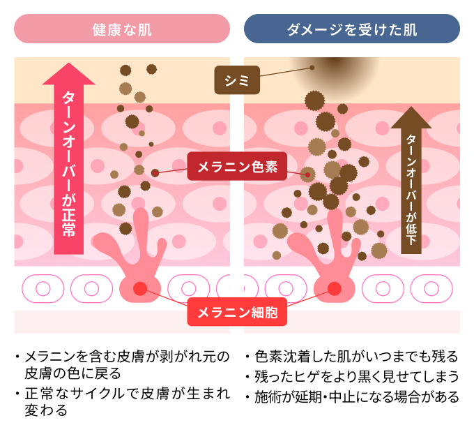 脱毛直後のヒゲ剃りは色素沈着の原因になる