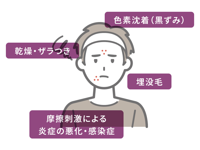 脱毛直後のヒゲ剃りで起こりやすい4つのトラブル