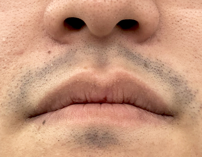 照射翌日※泥棒ヒゲ