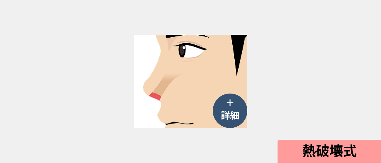 イラスト：鼻毛脱毛オプション