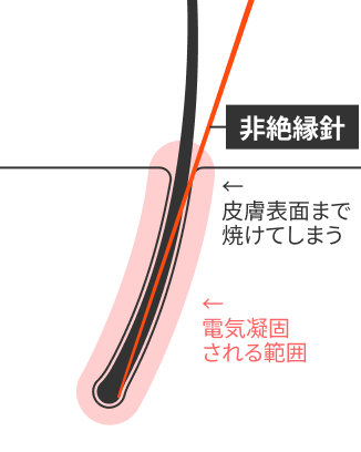 医療機関以外のニードル脱毛の仕組み