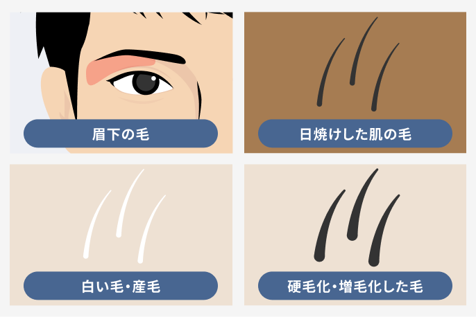 レーザーでは難しい毛や部位も脱毛できる