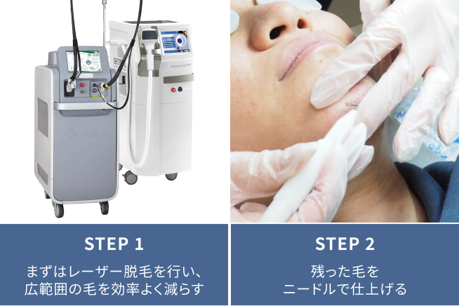 黒いヒゲにはレーザー脱毛、白髪ヒゲにはニードル脱毛という使い分け