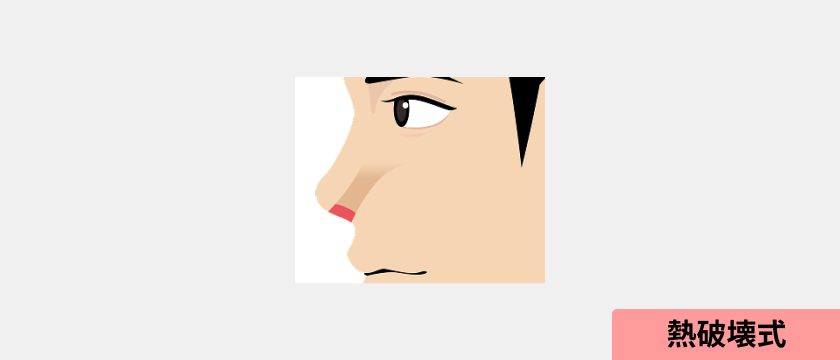 鼻毛脱毛オプションの照射範囲