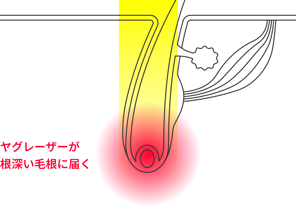 ヤグレーザーが根深い毛根に届く