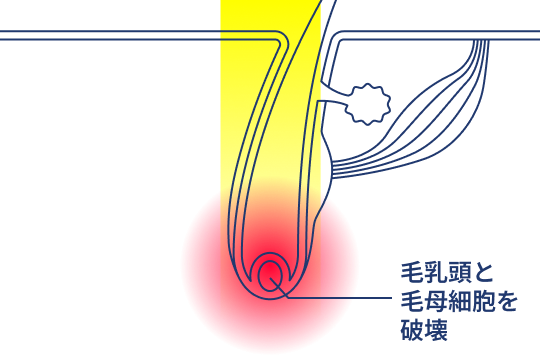 熱破壊式ヤグレーザー