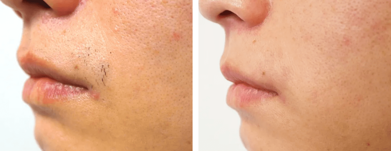 針脱毛の症例写真