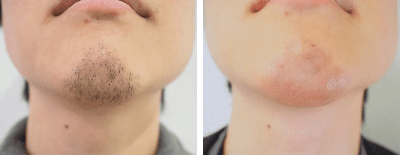 針脱毛の症例写真