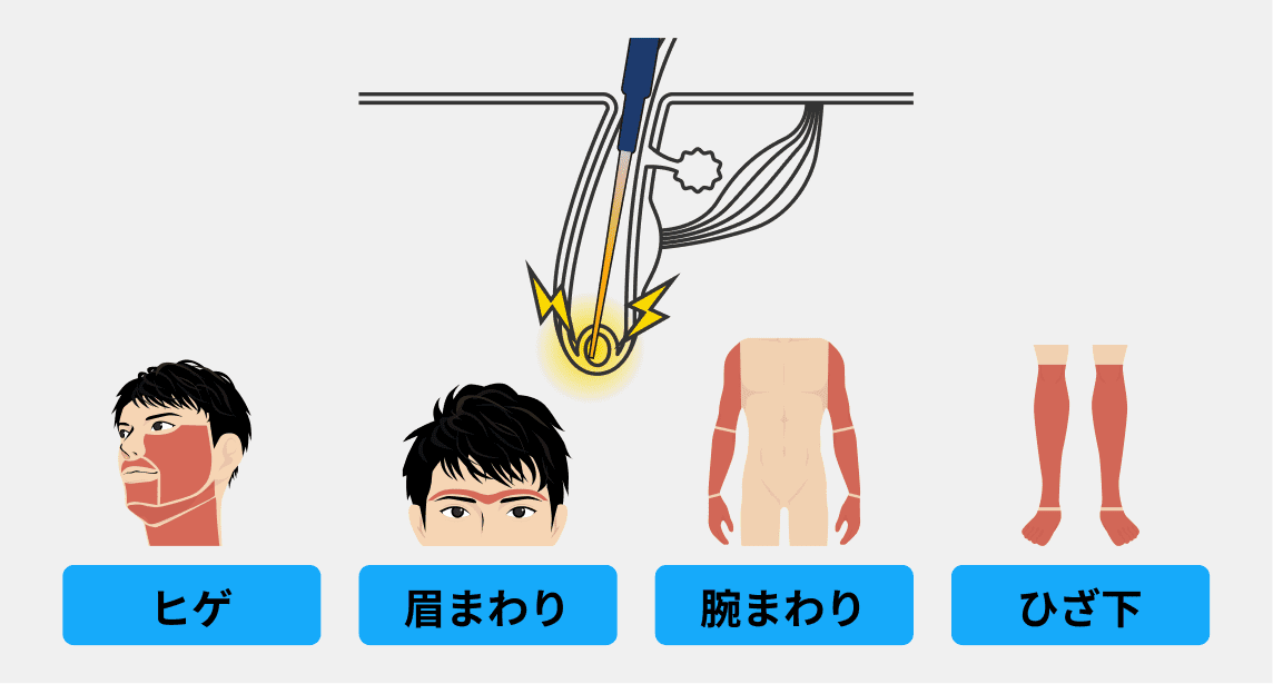 ニードル脱毛（針脱毛）