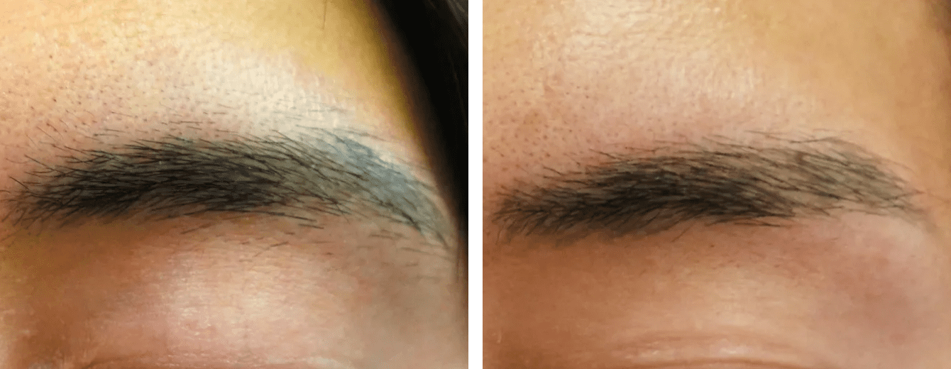 針脱毛の症例写真