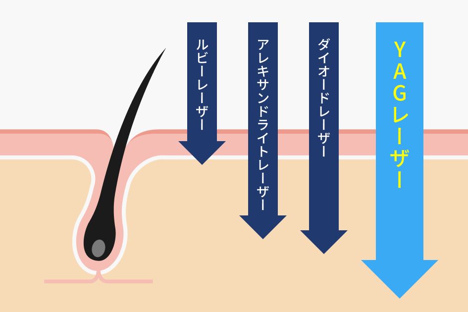 YAGレーザーの効果