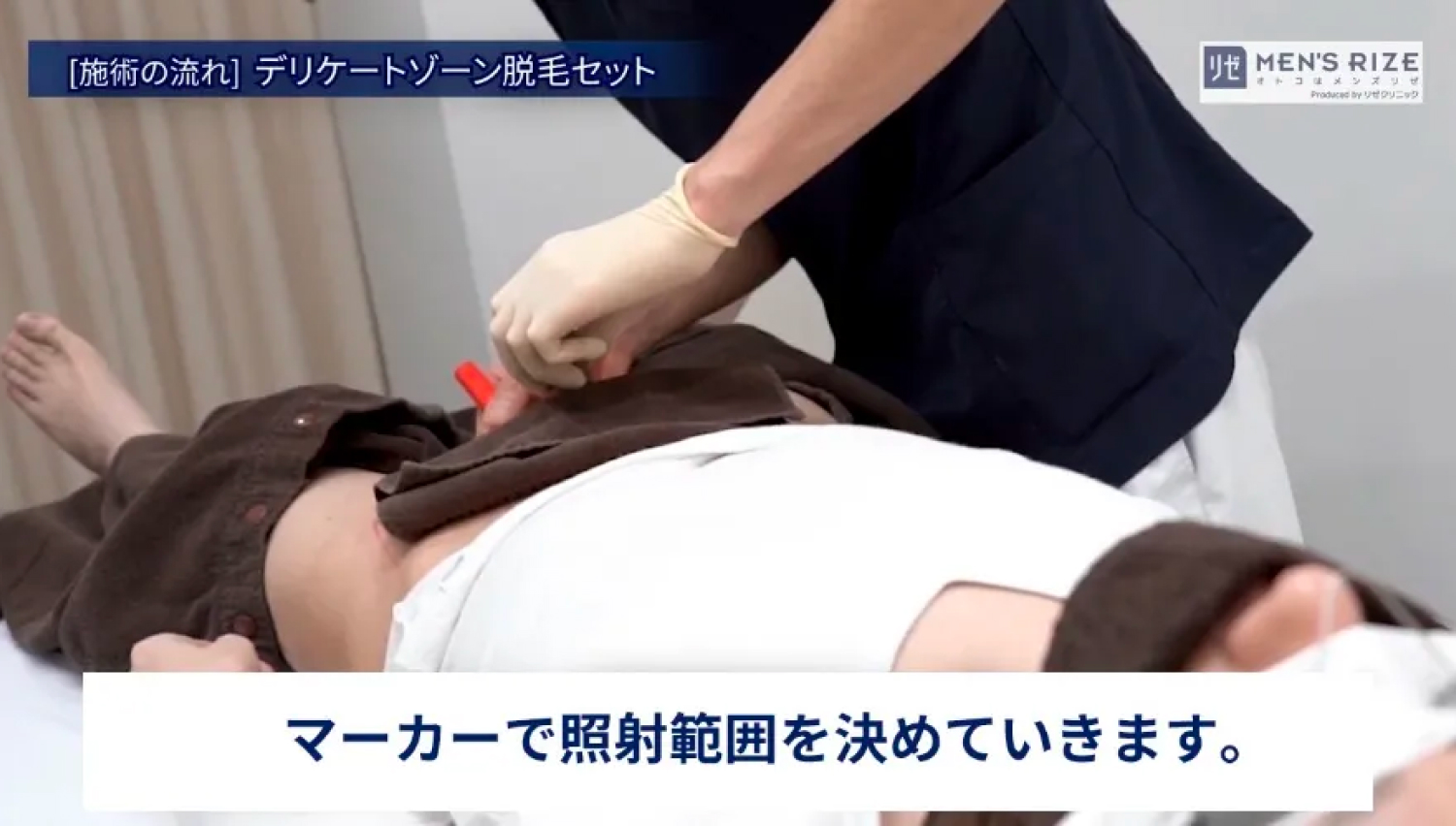 マーカーで照射範囲を決めていきます。