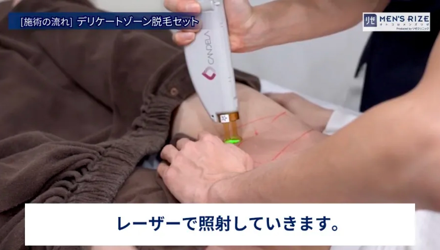 レーザーで照射していきます。