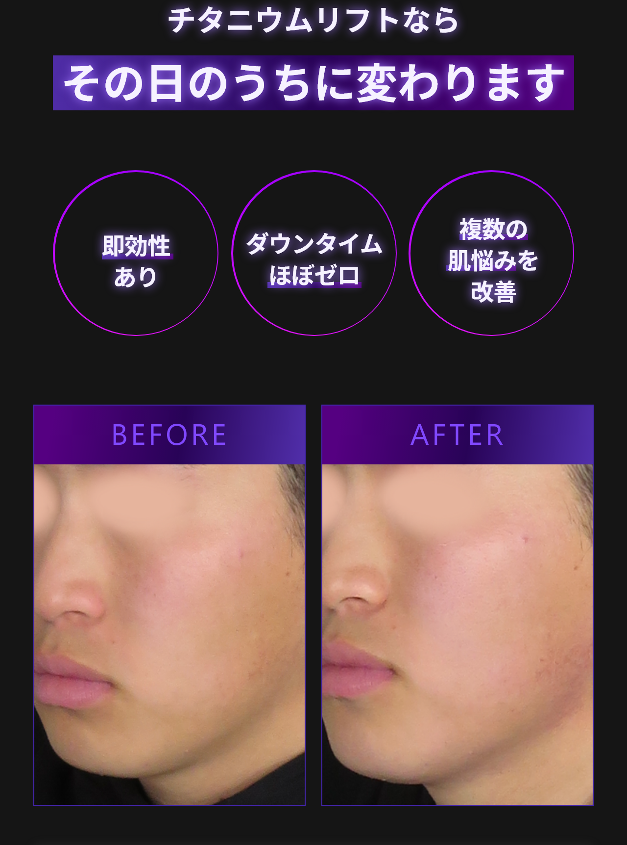 チタニウムリフトならその日のうちに変わります