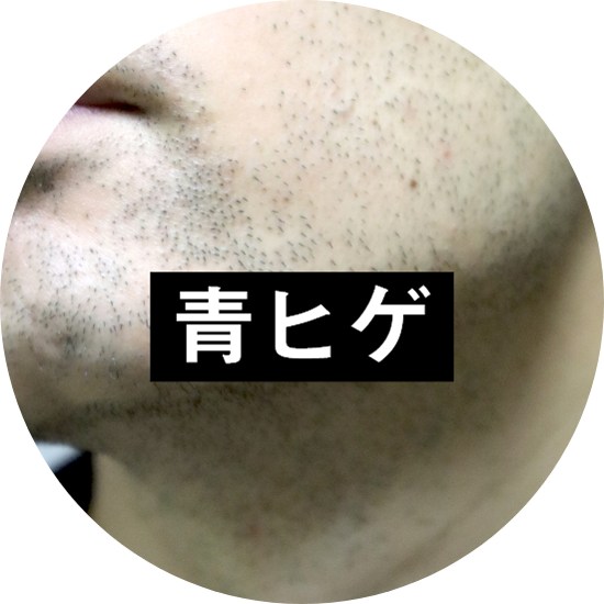 青ヒゲの原因と対策について解説