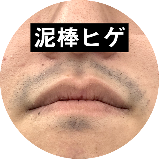 ヒゲ脱毛直後におきる泥棒ヒゲについて