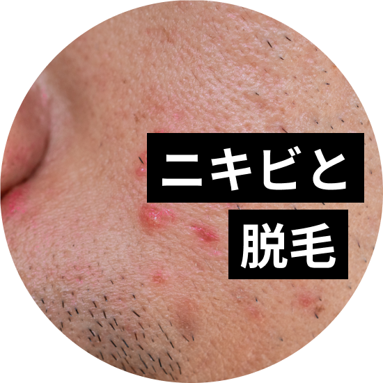ニキビと医療脱毛について