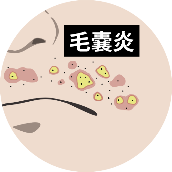 脱毛による毛嚢炎について