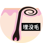 埋没毛の取り出し方は？原因と正しい対処法・予防法まで徹底解説