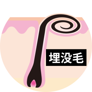 埋没毛の取り出し方は？原因と正しい対処法・予防法まで徹底解説