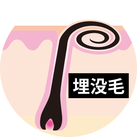 埋没毛の取り出し方は？原因と正しい対処法・予防法まで徹底解説