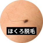 ほくろがあっても医療脱毛は可能！施術時の対応や注意点を解説
