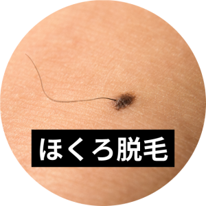 ほくろがあっても医療脱毛は可能！施術時の対応や注意点を解説