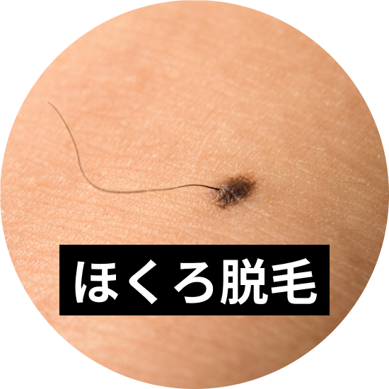 ほくろがあっても医療脱毛は可能！施術時の対応や注意点を解説