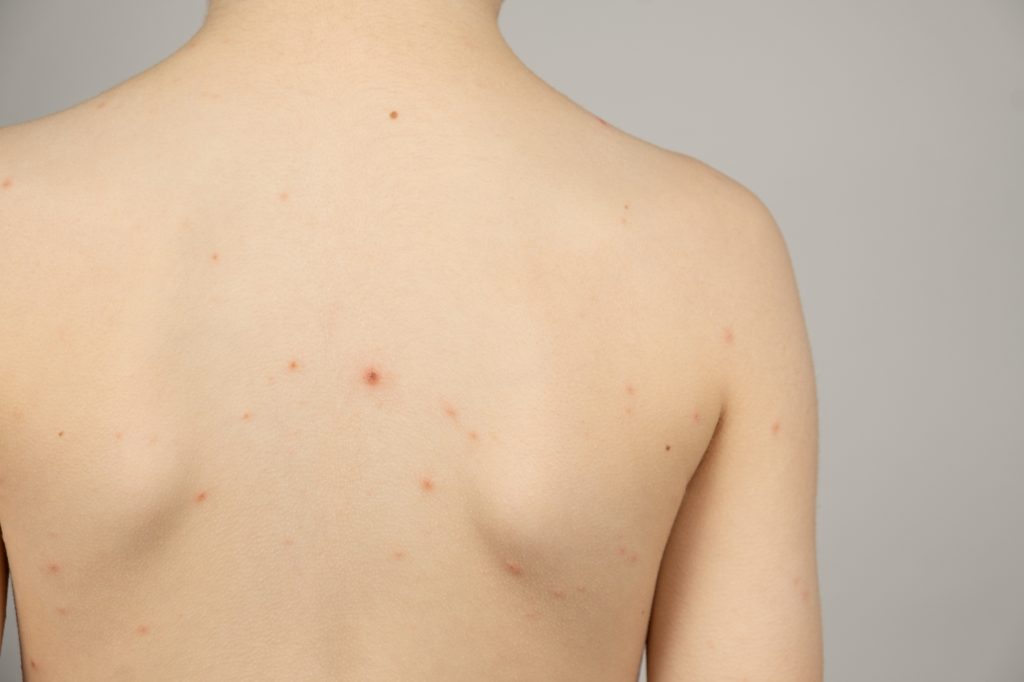 男性の背中ニキビが治らない原因は？対策・治療法を解説